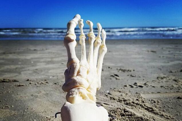 ампутированная нога Кристи Лойалл