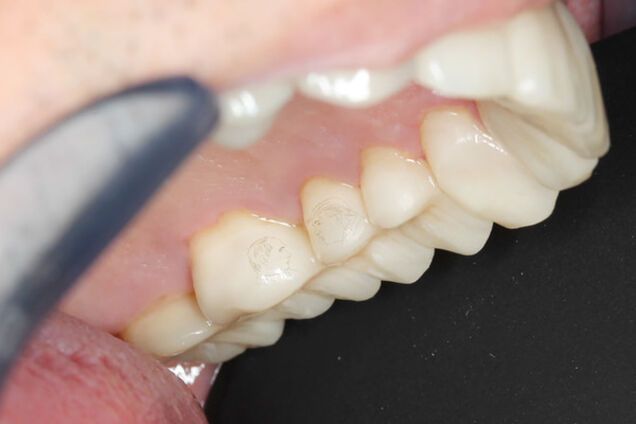 Гравировка на зубах с Путиным и Трампом