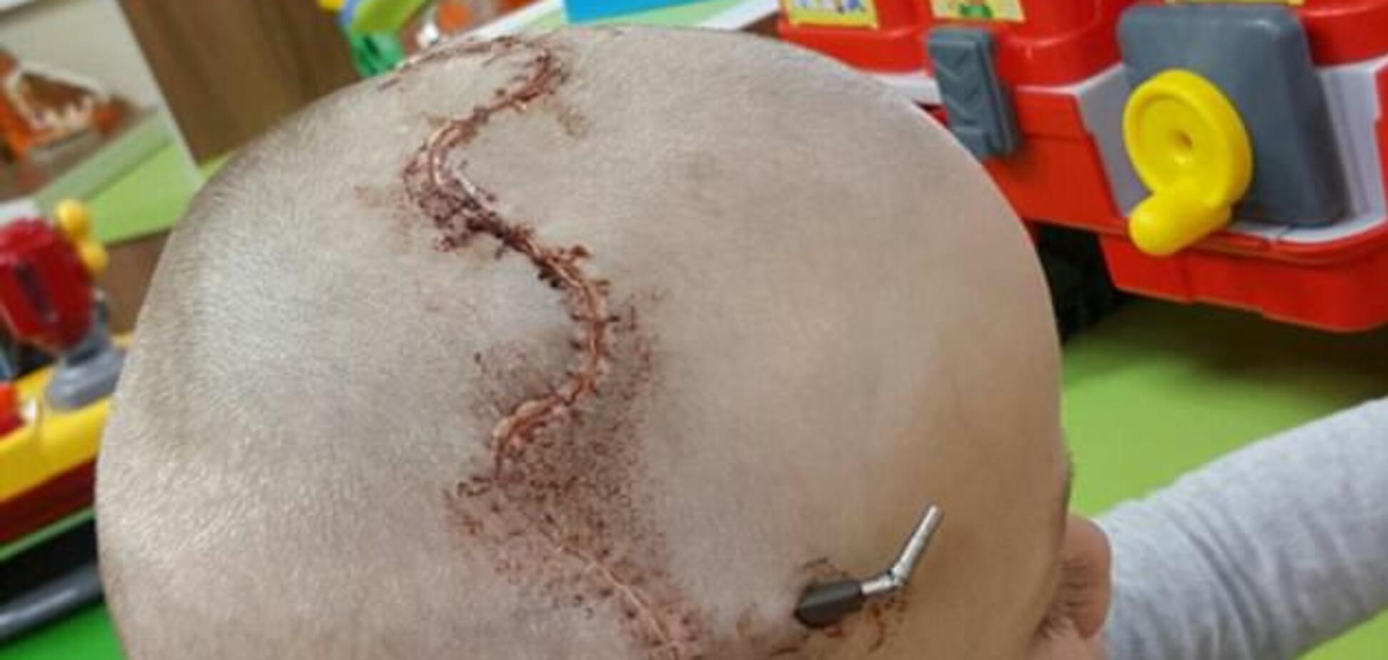 Собрали череп, как головоломку: 5-летнему мальчику провели опаснейшую операцию