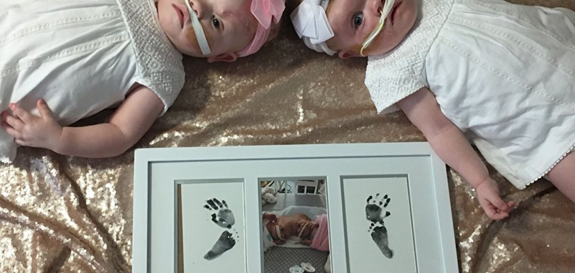 Дівчатка з однією головою: у мережі показали фото розділених сіамських близнюків зі США