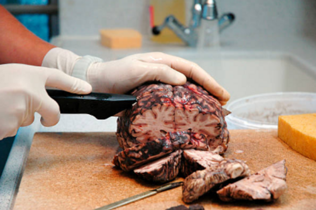 В США приоткрыли завесу огромного рынка частей человеческих тел: шокирующие подробности