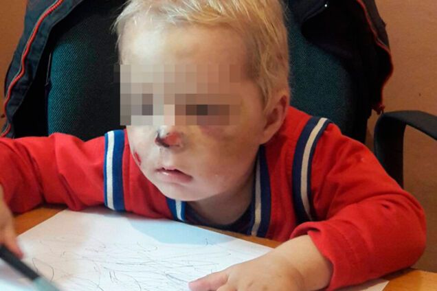 На Житомирщине мать жестоко избила двухлетнего сына: у ребенка сотрясение мозга и сломан нос