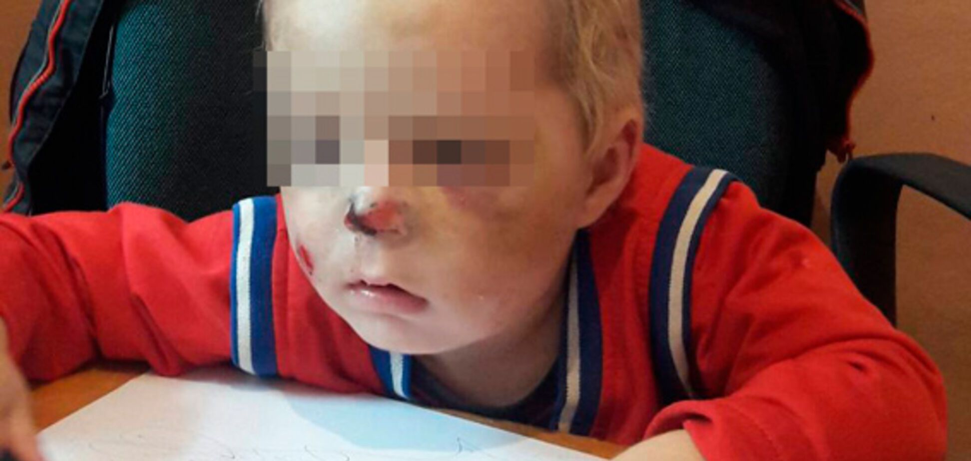 На Житомирщине мать жестоко избила двухлетнего сына: у ребенка сотрясение мозга и сломан нос