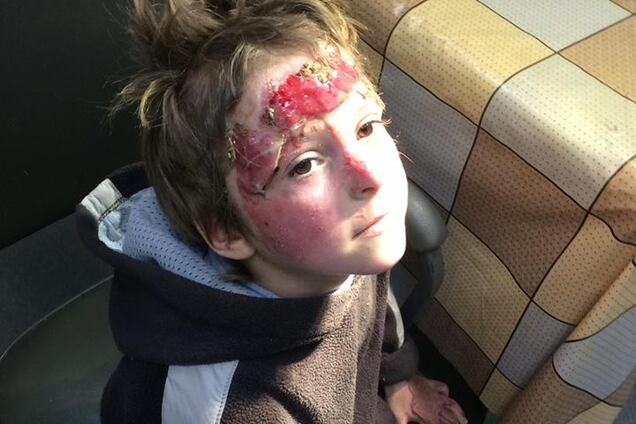 7-летний малыш сам снимал повязки... отдирая их с мясом