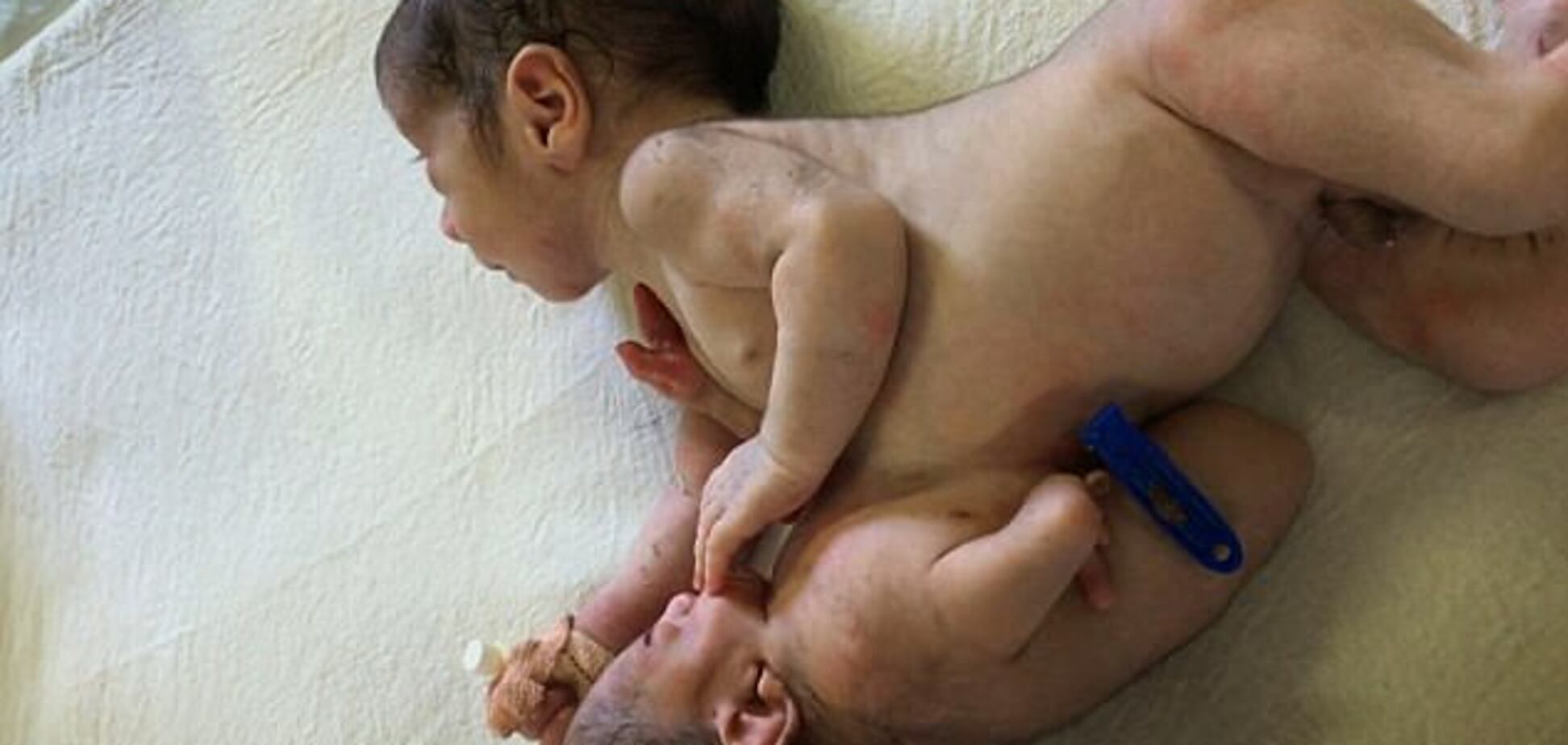 В Индии родился малыш с близнецом-паразитом на животе: шокирующие фото