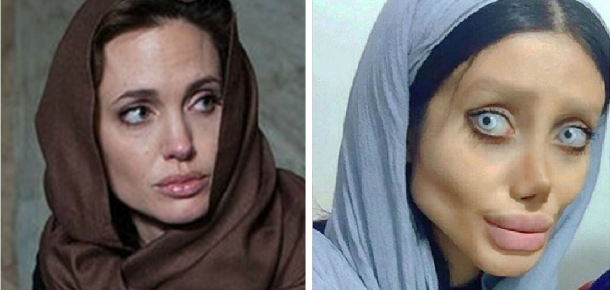 Как Джоли: иранка изуродовала лицо ужасной пластикой