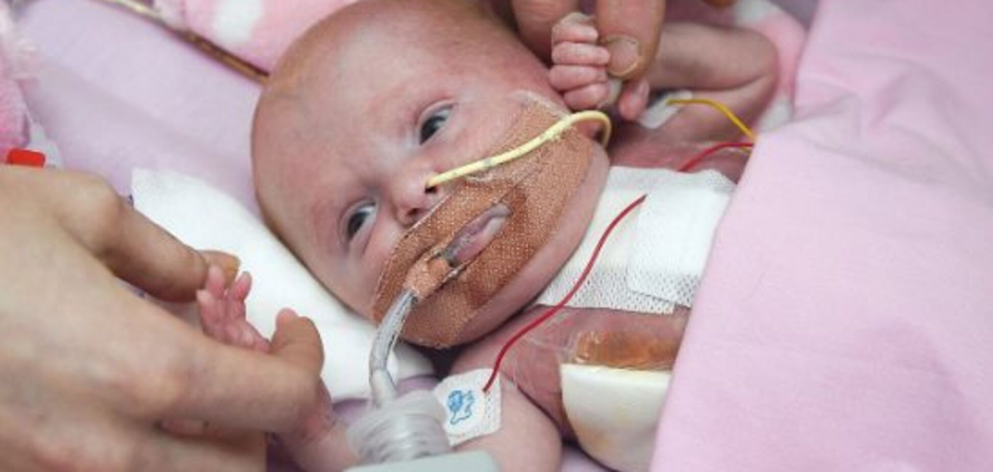 Різдвяне диво: в Британії лікарі врятували дитину з серцем назовні