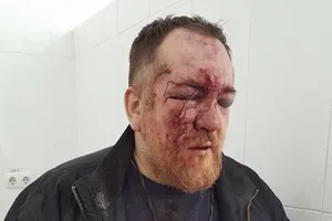 Это Харьков, детка: антимайдановцу сломали нос за "колорадскую" ленточку на 23 февраля
