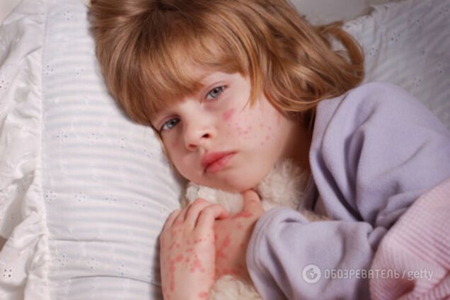 Доктор Комаровский о сыпи на лице ребенка: как понять, что это аллергия 