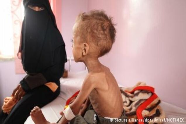 ООН: Близько 20 мільйонам людей загрожує голодна смерть