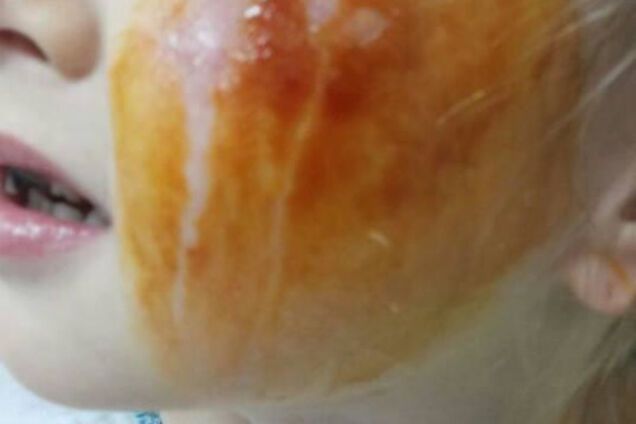 постраждала дівчинка