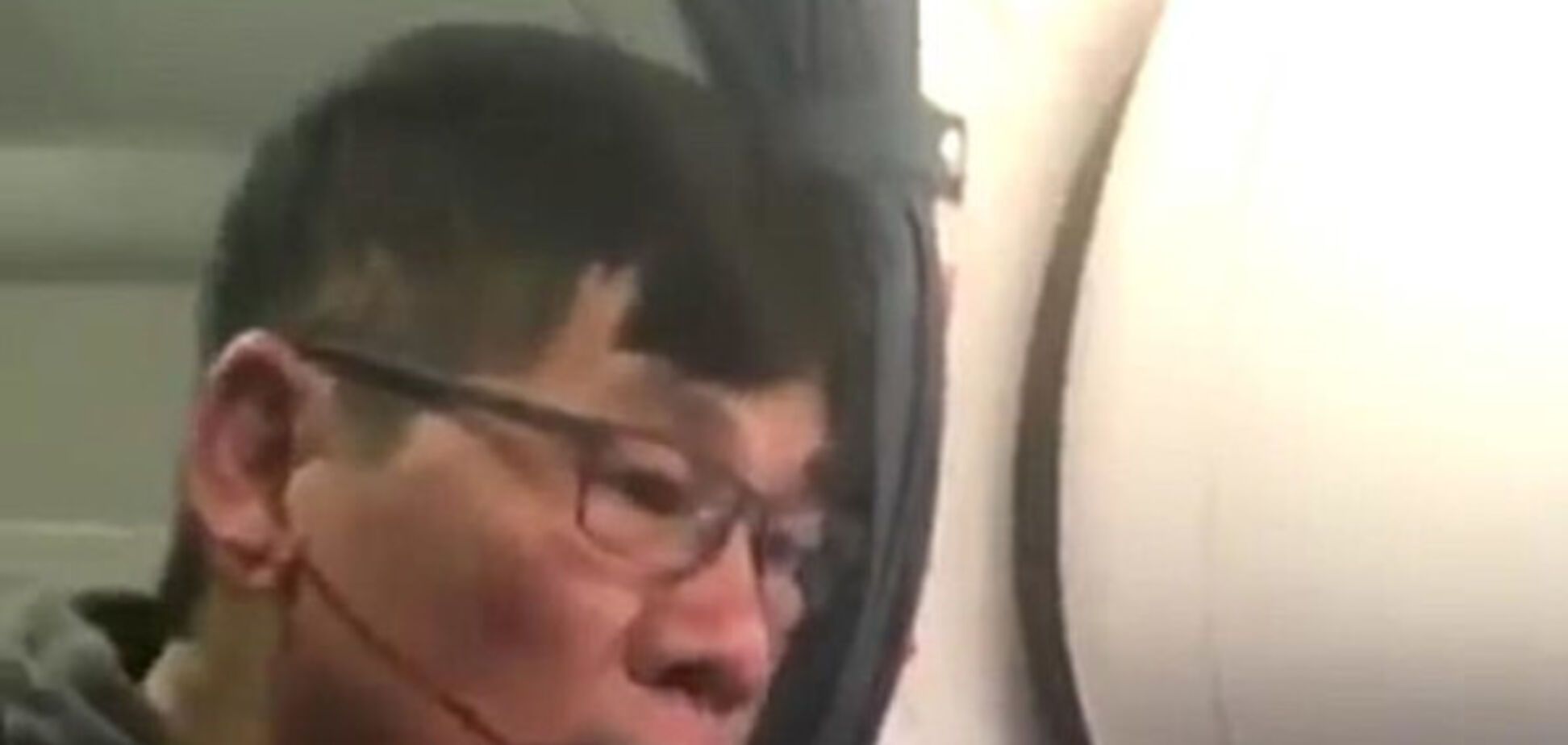 Потерпілий пасажир United Airlines потребує пластичної операції