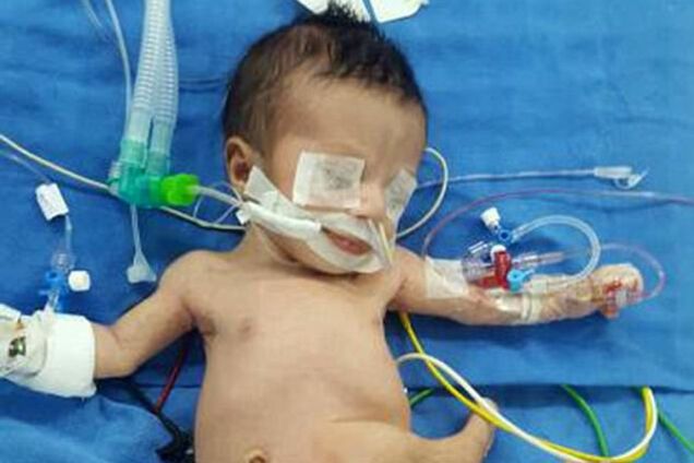 Ребенок с 8 конечностями из Ирака