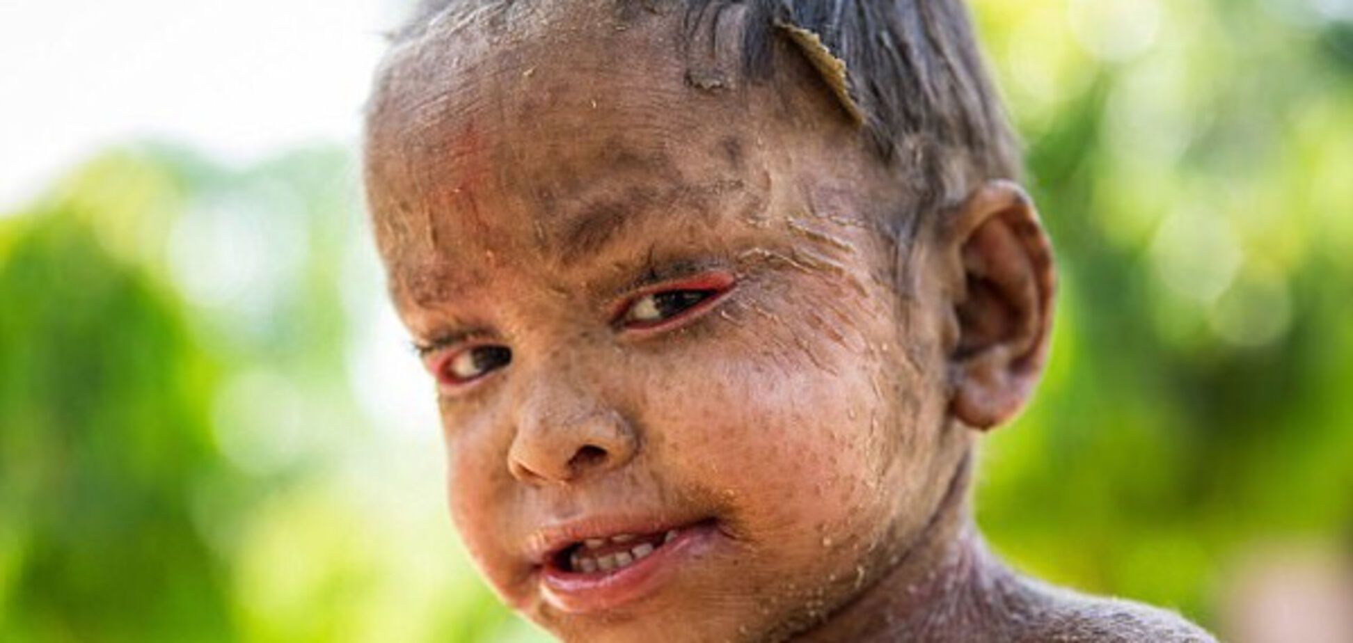 Двухлетняя девочка страдает от редкого заболевания, из-за которого ее кожа похожа на чешую ящерицы