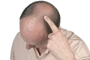 облысение