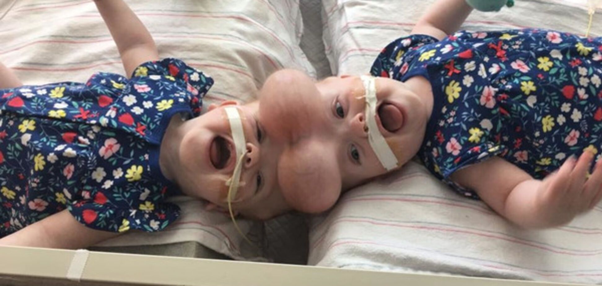 Одна голова на двоих: в США разъединили уникальных сиамских близнецов
