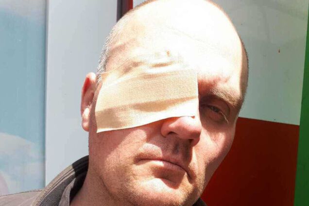 Местного жителя, который выступал за эко-заправку на Ревуцкого, активисты частично лишили зрения