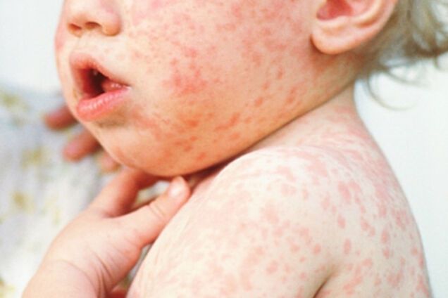 Заболевание корью