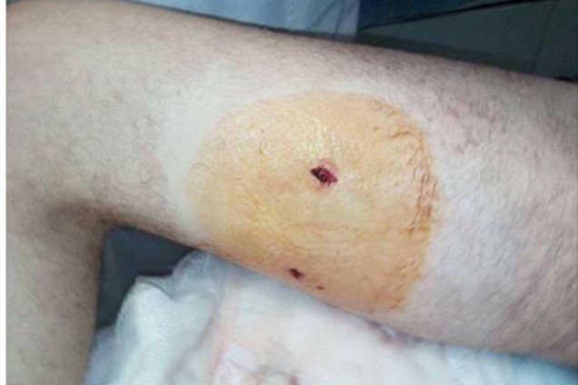 Ранение Евгения Дейдея