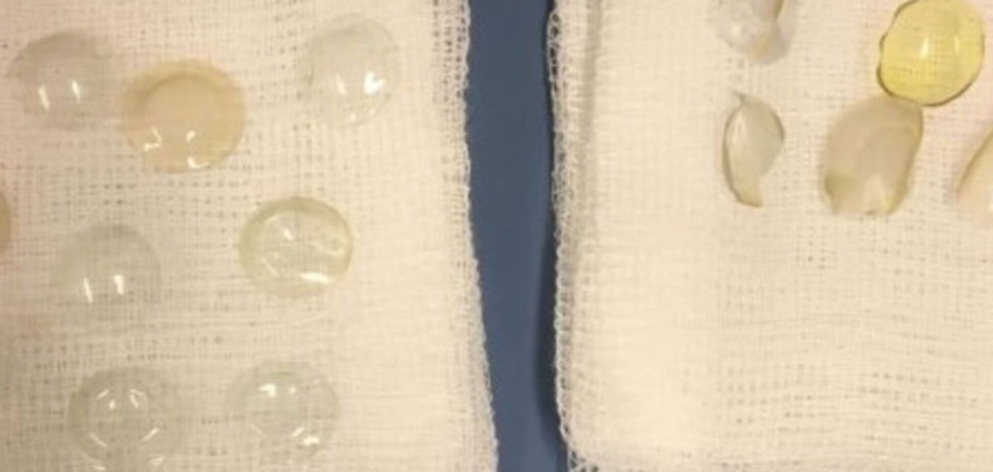 Контактні лінзи