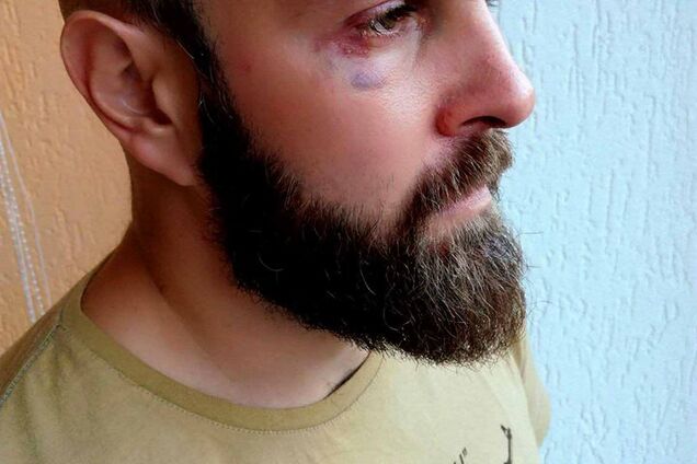 Произвол системы: в Житомире известного активиста избили и самого обвинили в покушении