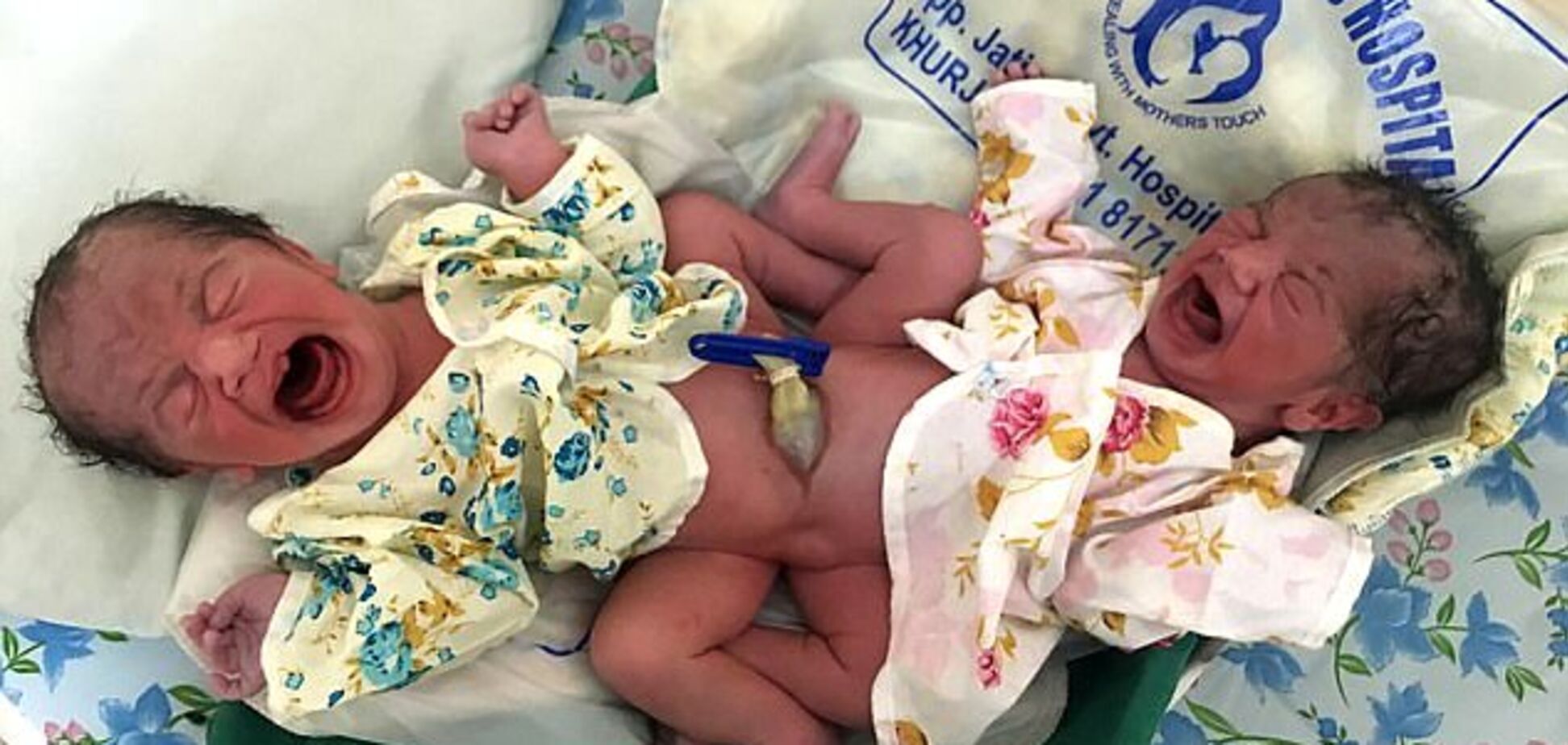 В Индии родились сиамские близнецы непонятного пола: опубликованы фото 