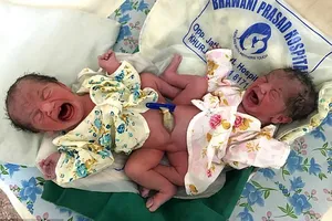 В Индии родились сиамские близнецы непонятного пола: опубликованы фото