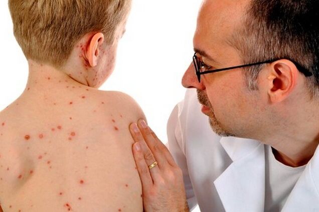 Эпидемии нет? В Минздраве сделали неожиданное заявление о кори в Украине