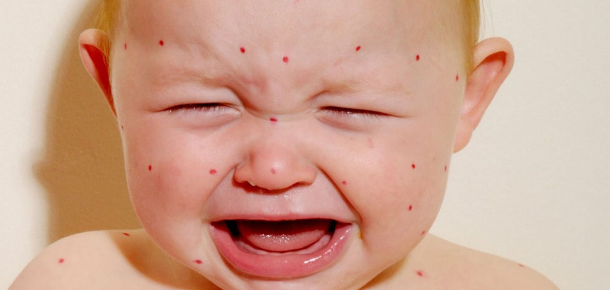 Кір атакує Київ: з'явилися нові дані про хворих