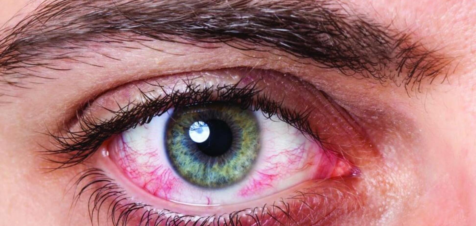 Синдром сухого глаза: причины 