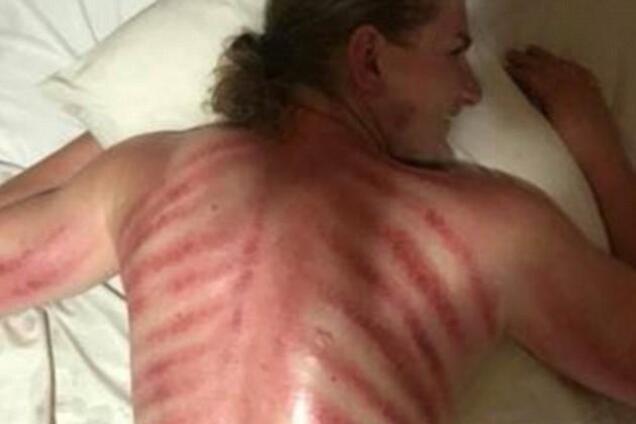 ''Вытащил красного дракона'': туриста на Бали покалечил массажист