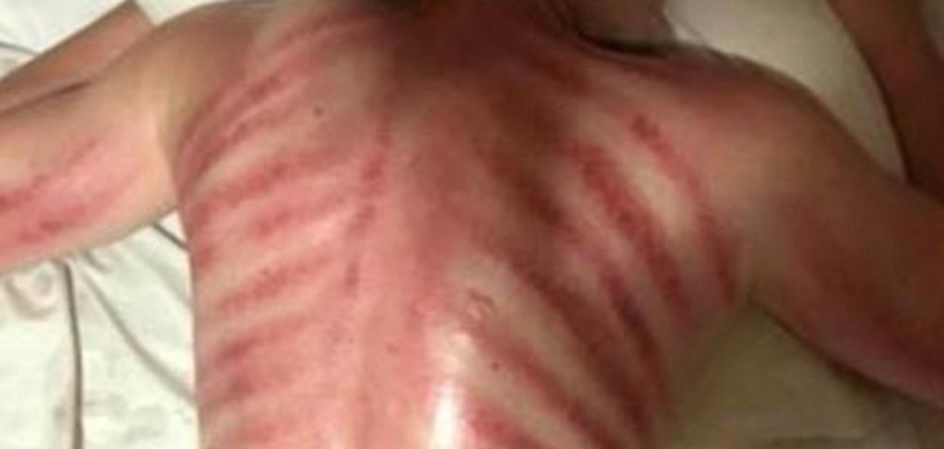 ''Витягнув червоного дракона'': туриста на Балі покалічив масажист