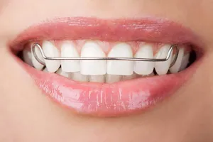 Какие существуют 5 самых популярных мифов о съемных брекетах