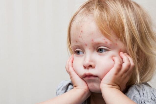 ''Прирівнюється до вбивці'': Комаровський різко висловився про вакцинацію