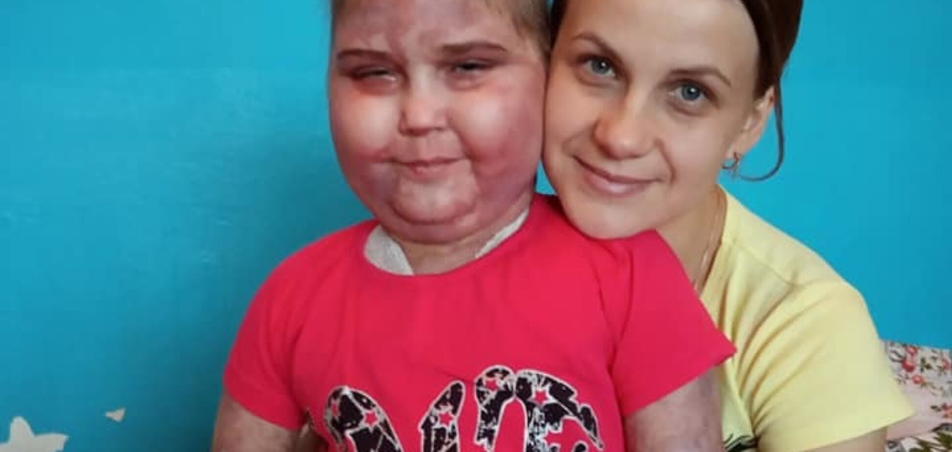 ''Виписали в кривавих бинтах'': в Києві дитину з раком виставляють на вулицю, лікарня заперечує
