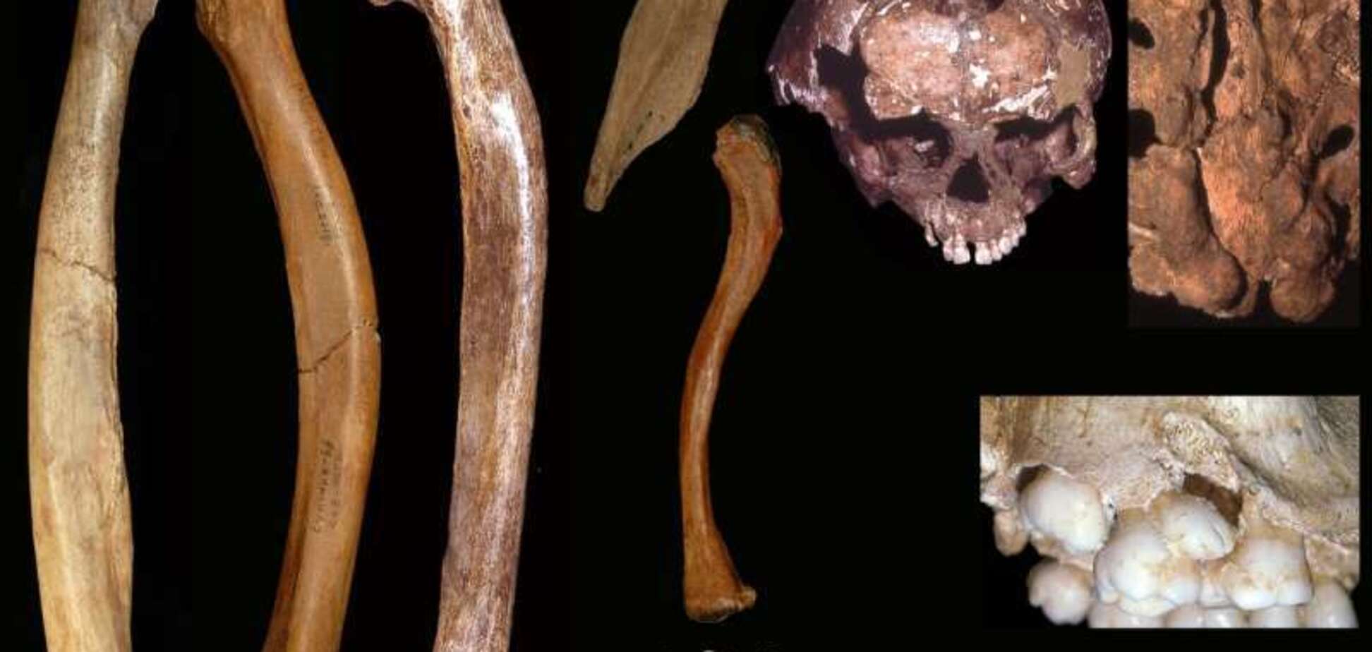  Искривленные руки и деформированные челюсти: стало известно о жутких аномалиях у древних людей