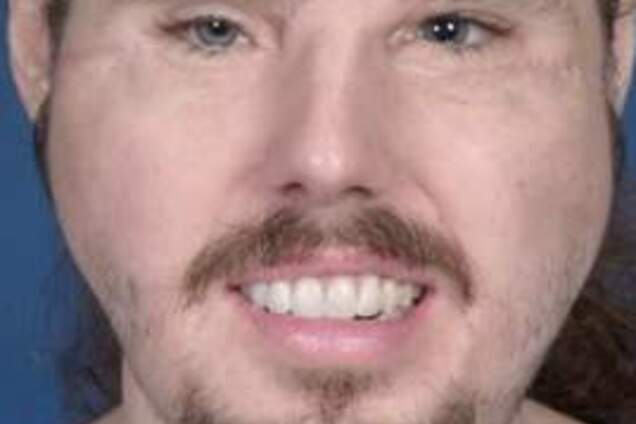 Американец удивил весь мир пересаженным лицом: фото до и после