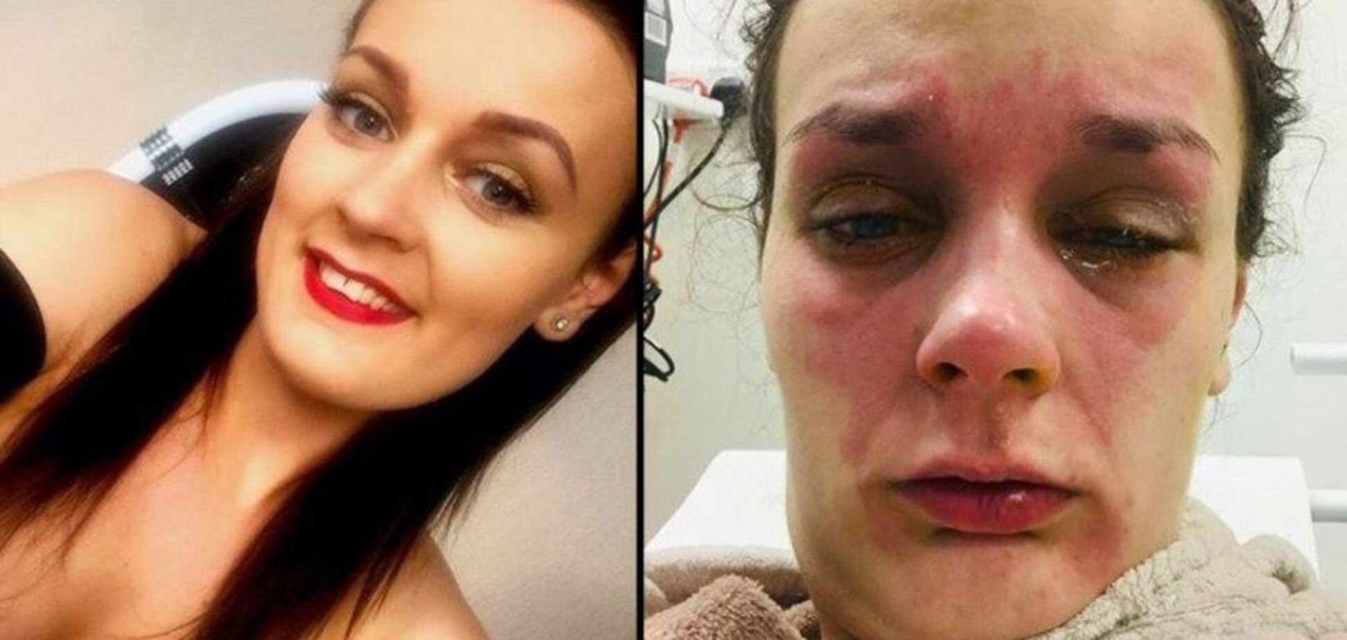 В Британии девушка проверила на себе миф о яйце в микроволновке: жуткие фото