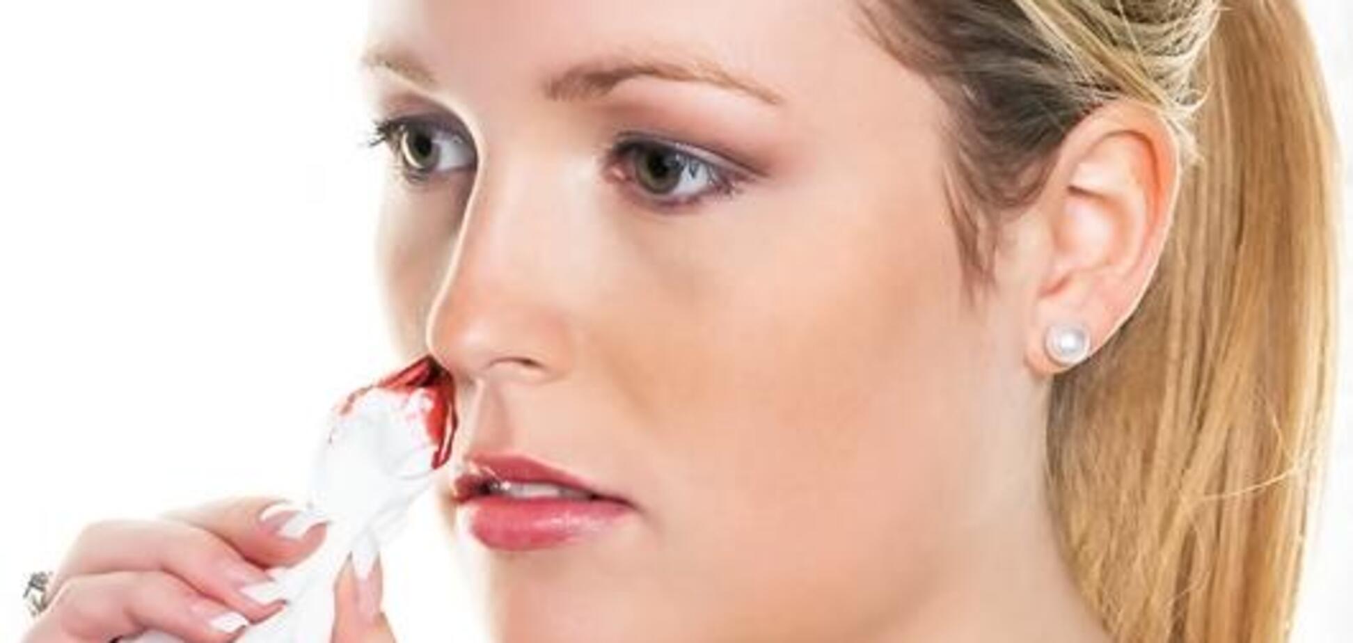 Носовое кровотечение - как реагировать на проблему