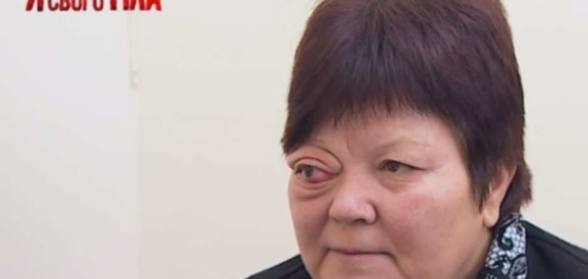 'Я соромлюсь свого тіла': як рятували око, яке випадає