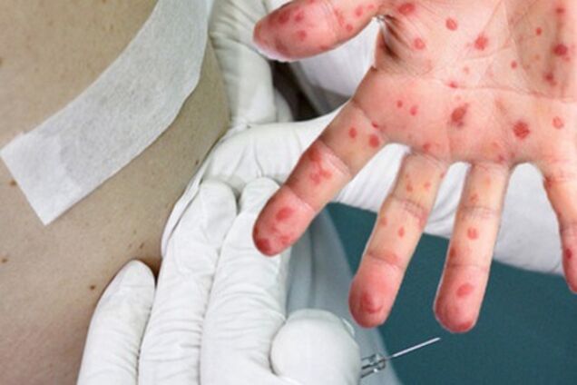 На відомому львівському заводі серед працівників спалахнула кір