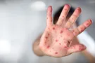 Корь атакует Днепр: названы цифры