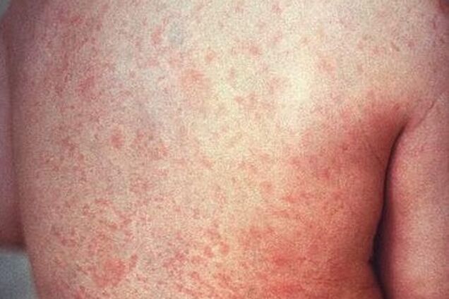 У Києві батьки підняли паніку через вірус кору в дитсадку