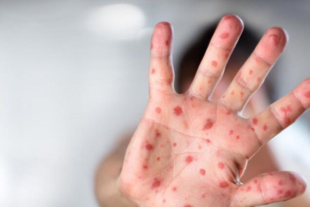 В киевском вузе произошла вспышка кори