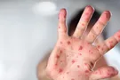 В киевском вузе произошла вспышка кори