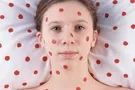 Вспышка кори в Киеве: названы самые опасные районы