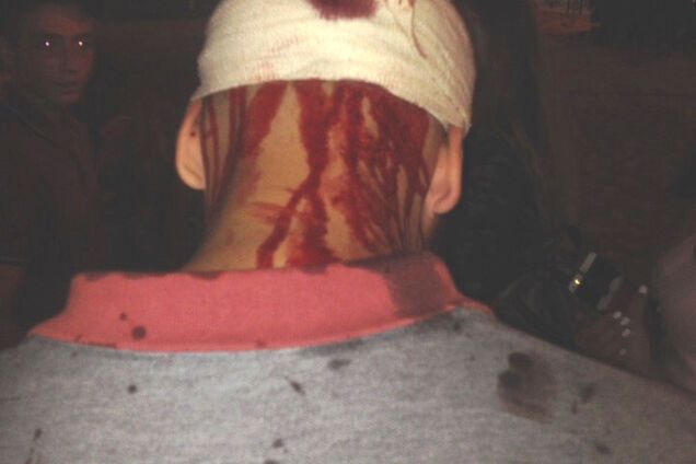 Их было человек 40 - избитый ромами в Киеве подросток