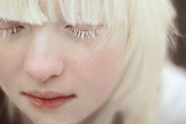 'Почему он такой белый?' Как живут альбиносы в Украине