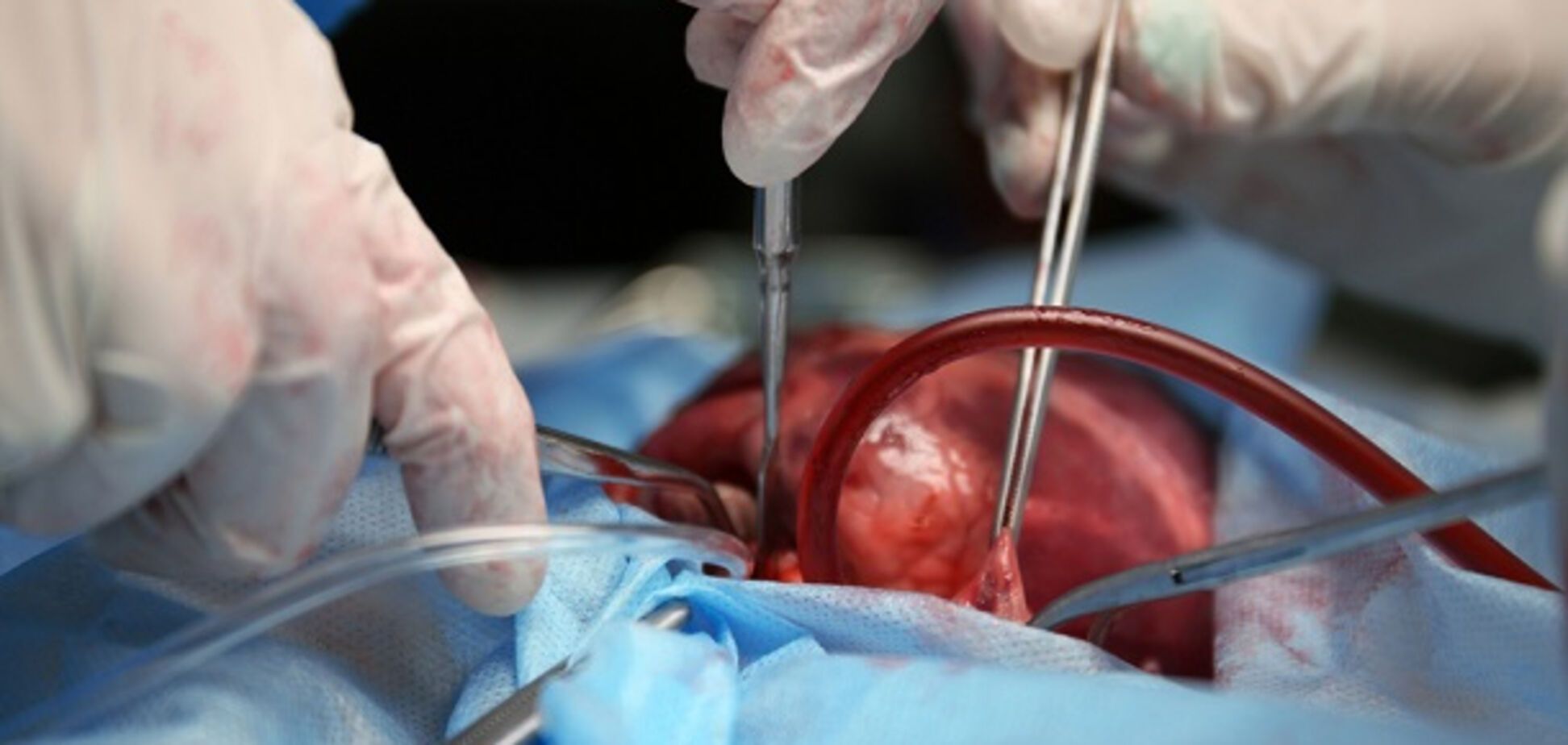 Ціна питання - мільйон: в Росії втягнули українців у 'чорні' схеми донорства