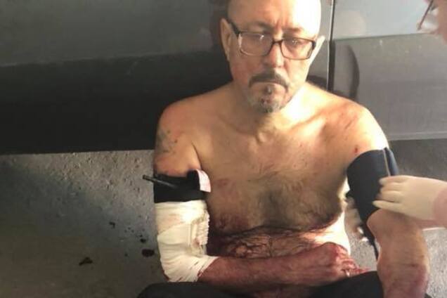 Розірвана рука, весь в крові: в Дніпрі лікарі потрапили у скандал, відмовившись рятувати пораненого
